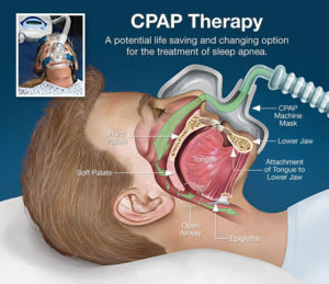 cpap-therapy